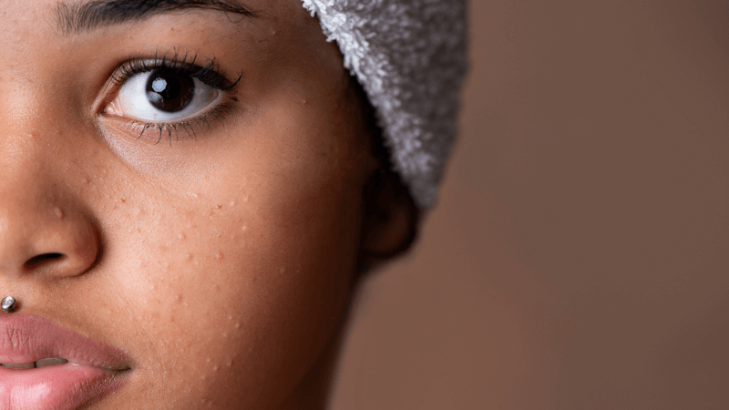 Perchè acne e brufoli in adolescenza