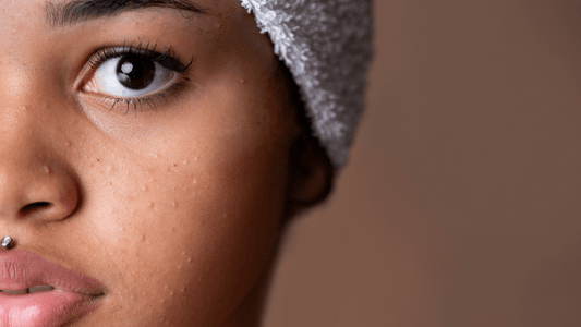 Perchè acne e brufoli in adolescenza