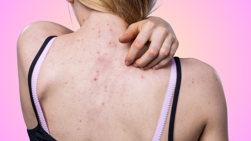 Brufoli e acne schiena, corpo