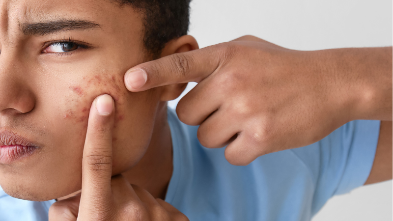 Acne e brufoli errori