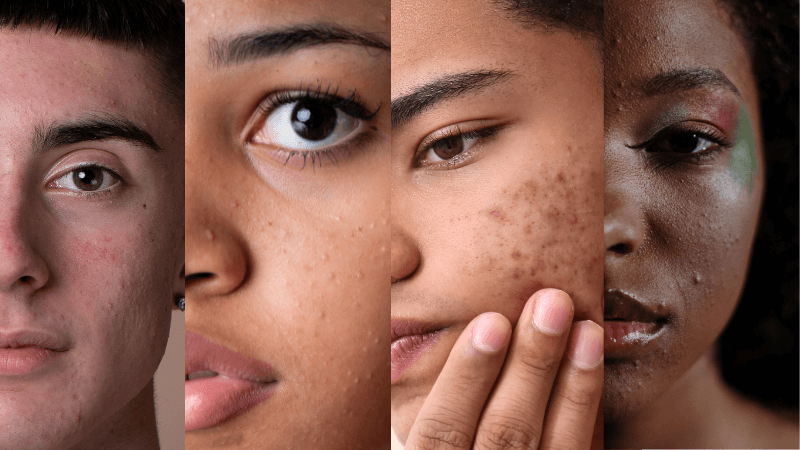 Brufoli e acne adolescenti
