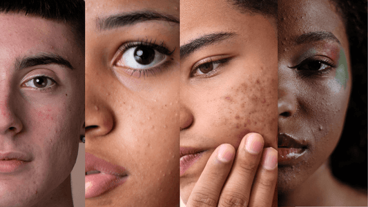 Brufoli e acne adolescenti